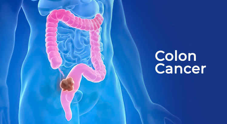 Colorectal Cancer (Male/ Female): 50 Plus